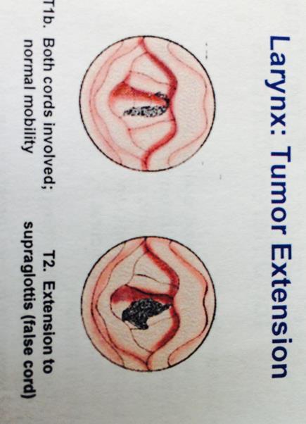 T-CATEGORIES: EXTENSION Example: Larynx T1 One/both vocal cords, normal mobility T2 Extension to supraglottis T3