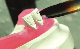 Physical templates are used to align the occlusal plane and prescribed arch form in the wax and plaster setup.