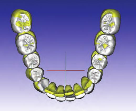 then iteratively adjusting the position of teeth (Figure 4A-B).