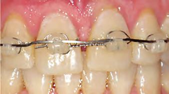 Finishing Advantage #8: Selective Ligation Once the alignment of teeth is achieved, it is generally time to selectively ligate the wire to the base of the slot for control and finish.