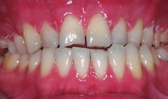 on the anterior teeth for interim