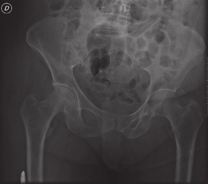 Case Reports in Orthopedics 3 Figure 3: Postoperative X-ray examination. (c) Figure 4: Clinical evaluation at 2-year follow-up. weight for 4 weeks.