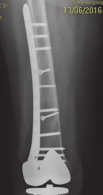 Delayed reduction of hip dislocation is more difficult to obtain and it is related to several complications such as avascularnecrosisoffemoralhead[9].
