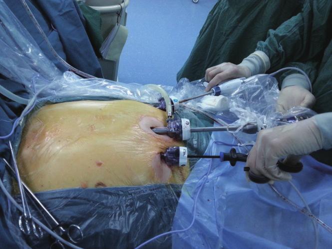 fter dissecting the normal parts of the thymus, the thymus with the tumor was carefully assessed.