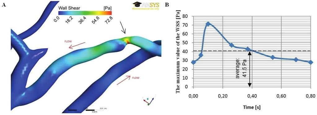 Simulations of the blood flow in the arterio-venous fistula for haemodialysis 73 vein stenosis where blood velocity rapidly decreases and the blood flow is locally reversed.