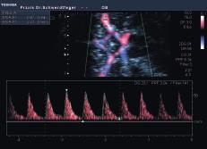 resolution Pulse wave (PW) Doppler of the middle cerebral artery Often, it is not easy