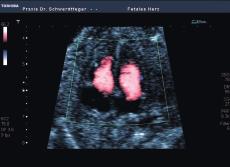 needed in fetal echocardiography for easy detection of valvular