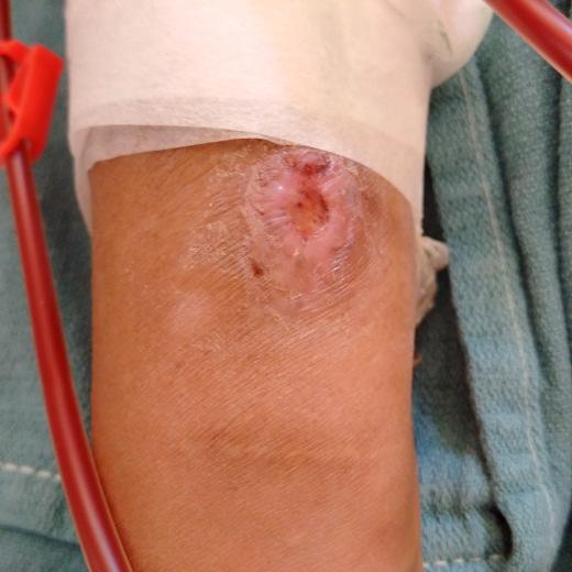 Healing BH Buttonhole Infections: Literature Healing Buttonhole Infection Doss et al.