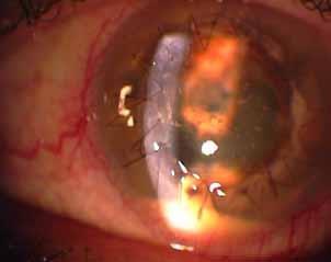 Comments (II) Infectious uveitis has been usually treated at the time of cataract surgery Attention: In Hx (+) of herpetic origin uveitis