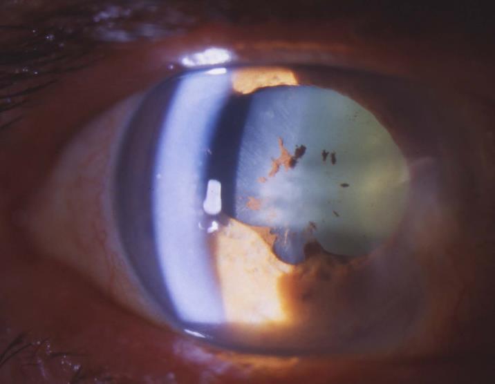 cataract: Subcapsular