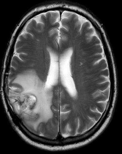 CNS Cancer Surgery is the primary treatment for patients with GBM or anaplastic astrocytoma Available evidence suggests that gross total resection is
