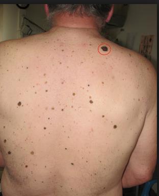 Melanoma Melanoma in older patients is characterized by the presence of thicker and more ulcerated tumors compared to younger patients