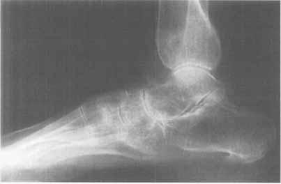 Acta Orthop Scand 1997; 68 (6): 577-580 577 Transient osteoporosis of the foot Bone marrow edema in 4 cases studied with MRI Emilio Calvo, Luis Alvarez, Dario Fernandez-Yruegas and Carlos Vallejo