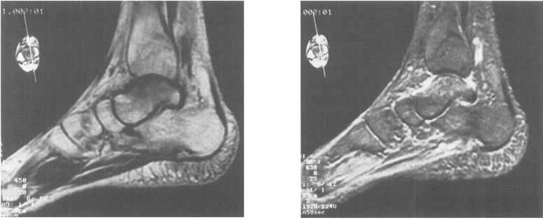 Accepted 97-06-1 1 We report 4 patients with transient bone marrow edema of the foot.