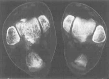 The abnormal signal extended into the body of the talus. On gradient-echo T2-weighted images, the abnormal area displayed relatively high signal intensity.