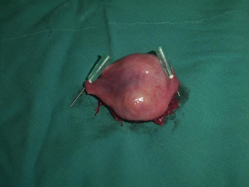 5 cm that appeared to arise from the bladder wall and extended into the bladder