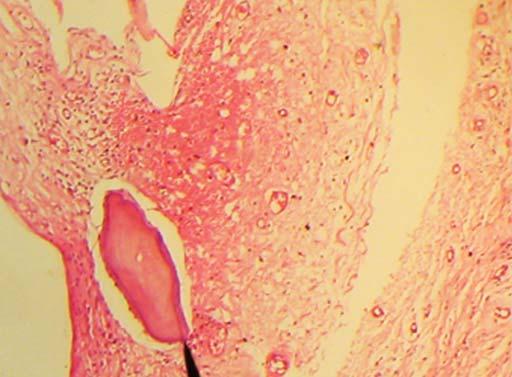 The histopathologic examination of the biopsied specimen showed a characteristic epithelium of 4 to 10 cells thick.