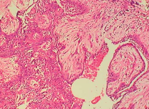 The cystic lining showed proliferation into fibrous capsule. The proliferating epithelium resembled follicles of solid ameloblastoma. Ghost cells were seen in abundance within the epithelium lining.