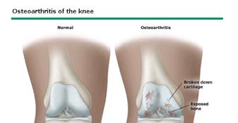 Osteoarthritis Rheumatology Update Richard Zweig, MD January, 2013 Degeneration of cartilage over time accompanied by increase in bone density and bone formation around the joint Risks include: