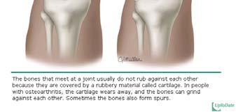 Inflammatory type has pain and stiffness X ray show joint space narrowing, subchondral sclerosis, bone cysts and osteophyte formation Most common joints: apophyseal joins of the lumbar and cervical