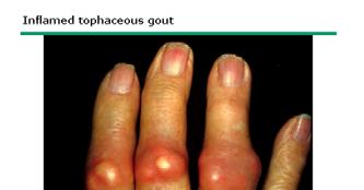 Gout Gout patients have an average of four comorbidities: HT, Lipids, DM and CKD Hyperuricemia causes HT in animal models Hyperuricemiamay i prove to be an independent risk factor for atherosclerosis