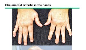 Gout Clinical Course Attacks separated in time, then becoming more frequent until the arthritis becomes chronic Chronic gouty arthritis is difficult to treat and is best prevented Explain this to