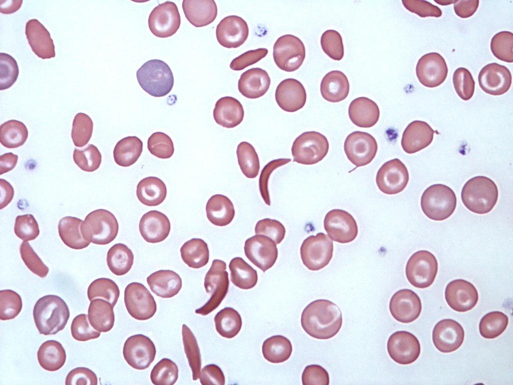 Diagnostic Case Studies: Leicester Royal Infirmary, Department of Pathology, July 2011, CC BY- SA SICKLE CELL BLOOD SMEAR TOP The distinctive blood smear displaying the presence of sickle- shaped red