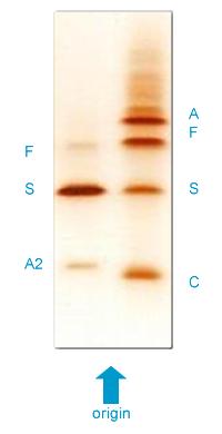 The IEF confirms the presence of HbS in the unknown sample (left panel) along with HbF and HbA2. The HPLC test showed a 3.