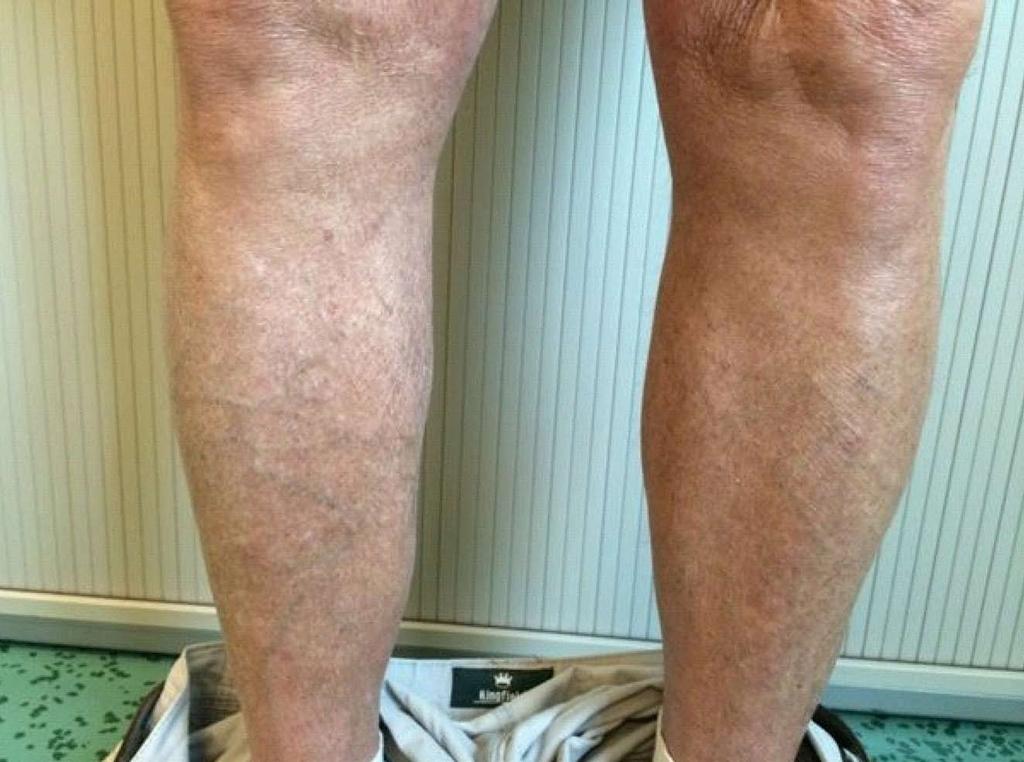 Piekaar RSM et al. Bilateral venous malformations within calf muscles legs. When the lesions are asymptomatic conservative treatment is preferred.