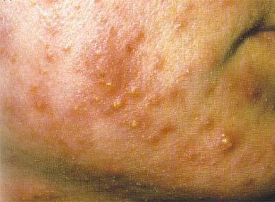 Pustules - these are pimples full of pus.