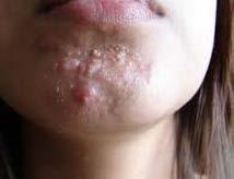 Cysts commonly cause scars.