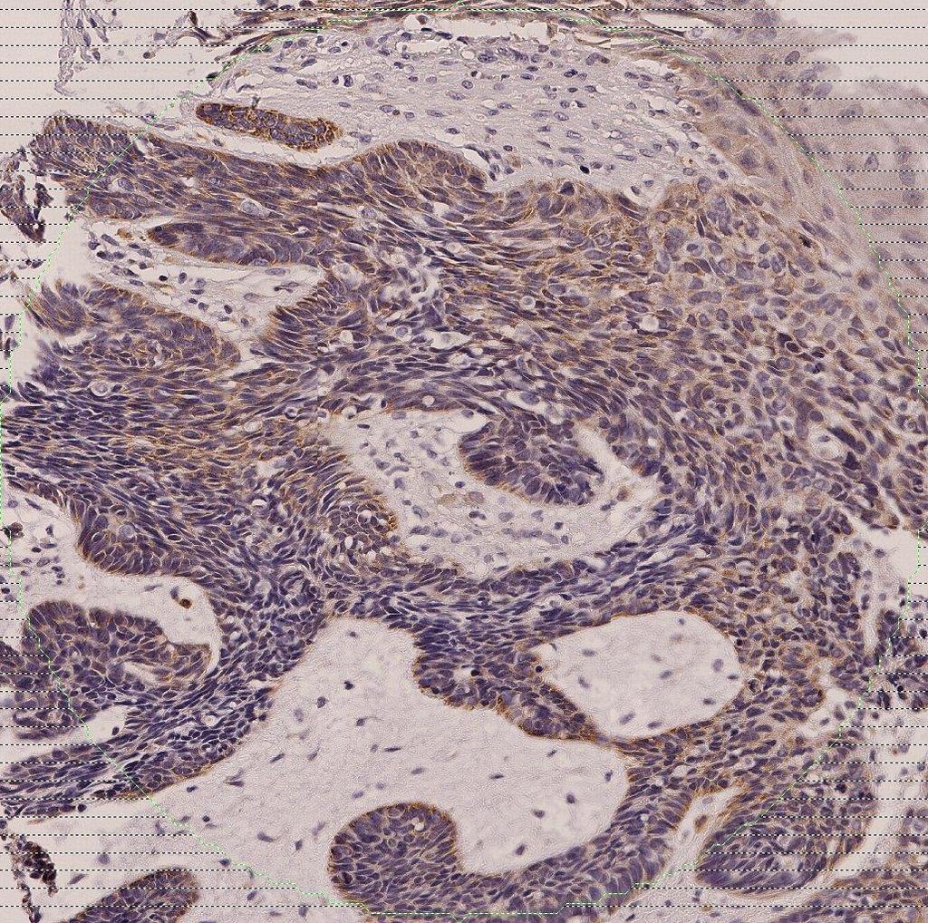 Tumor cell identification in skin tissue