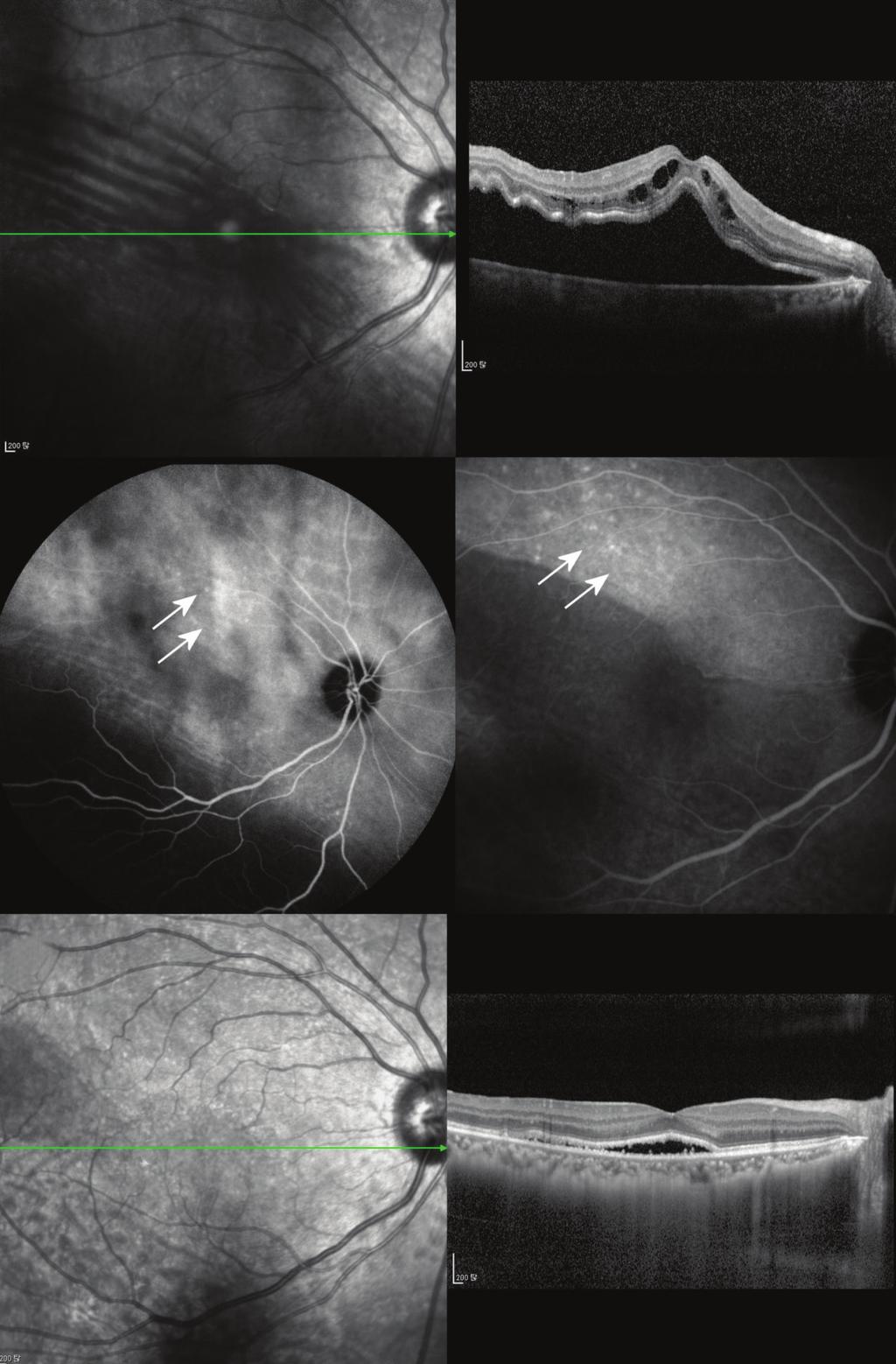 Korean J Ophthalmol Vol.31, No.5, 2017 A B A C D Fig. 1. A case with delayed absorption of subretinal fluid (case 9).