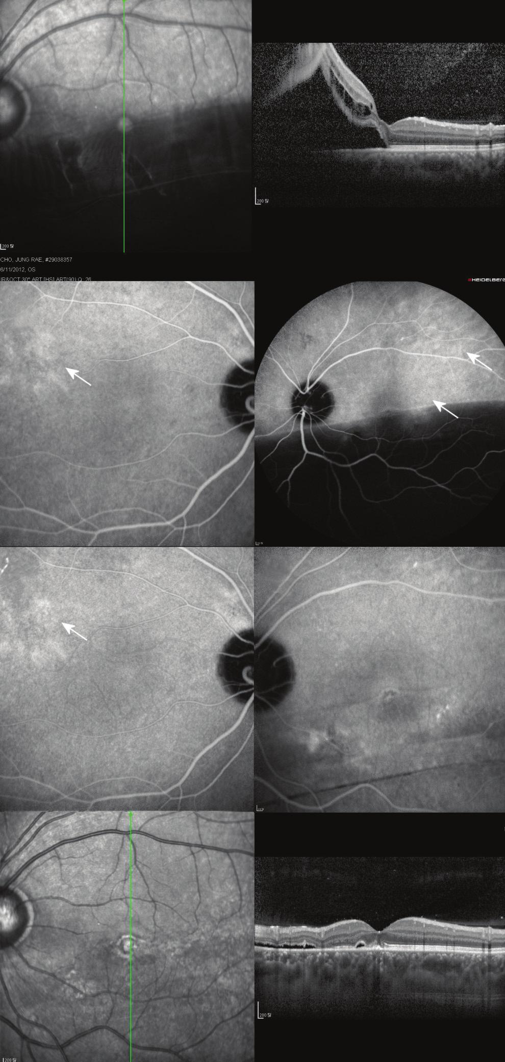 (B) Preoperative indocyanine green angiography shows choroidal vascular hyperpermeability (arrows) around the macula.