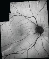 with Air Tamponade Case Reports in Ophthalmological Medicine Volume