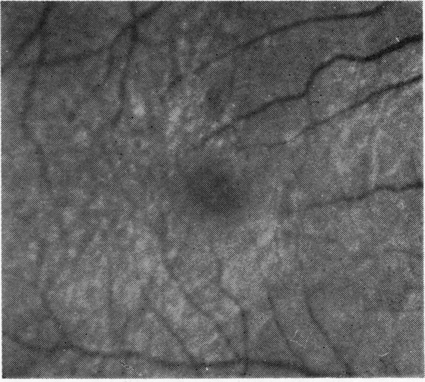 Macular abnormalities in the reattached retina FINAL VISUAL ACUITY occurred in a total of 17 patients (Figs. 7 and 8).