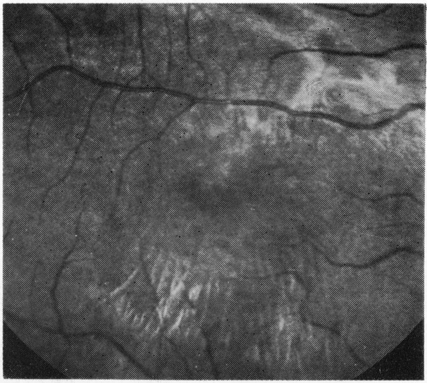 598 these. One patient had a minor disturbance in the retinal pigment epithelium and one had a cellophane maculopathy.