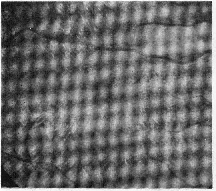 or persistent macular oedema. DURATION OF RETINAL DETACHMENT The duration of retinal detachment varied from less than 1 week in some patients to more than 2 years Fig.