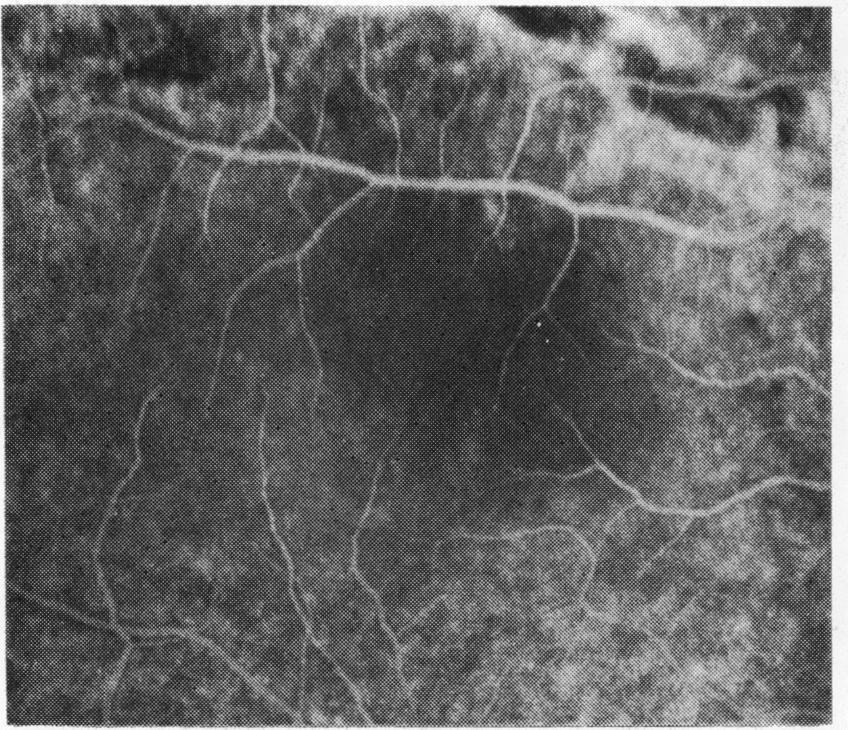 5c Red-free photograph 9 months after retinal reattachment. The intraretinal cystoid spaces are no longer visible, but there are retinal pigment epithelial changes at the macula Fig.