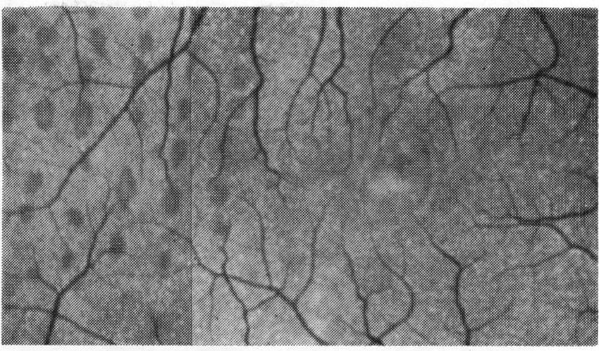 Of 14 eyes in which preretinal fibrosis occurred at the macula after surgery 9 had local explants and 5 had encircling bands; 8 were drained and 6 were not.