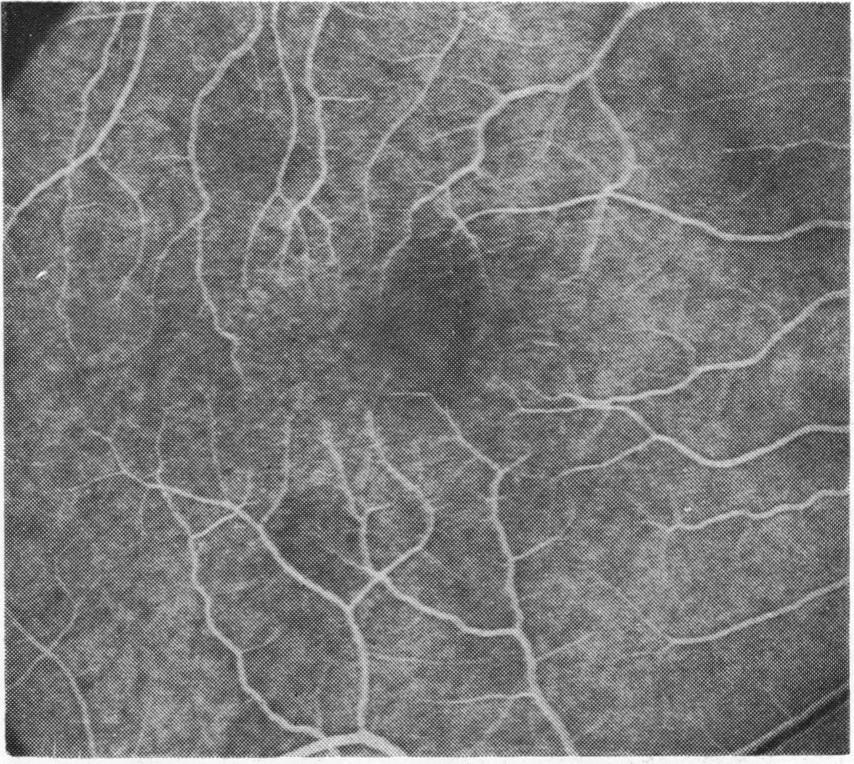 Discussion Macular abnormalities were identified in the majority of patients with severely reduced vision after retinal reattachment.