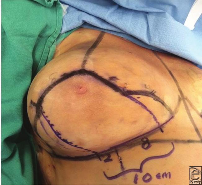 Careful dissection in the region of primary innervation to the nipple by avoiding breast tissue resection in either too superficial or too deep of a plane can result in better