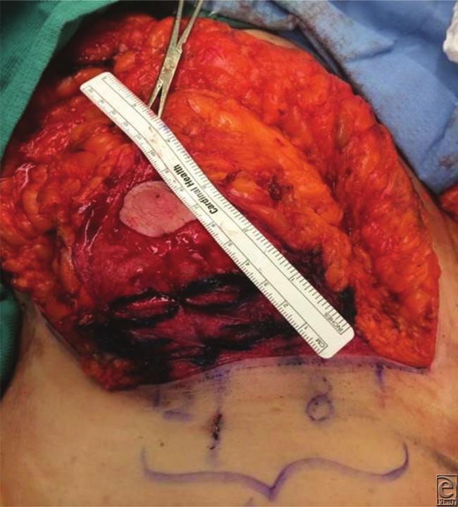 eplasty VOLUME 17 Figure 5. The inferior dermal pedicle after plication.