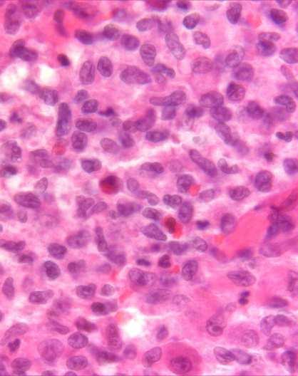 Funny looking cells Langerhanscell histocytosis CD1a