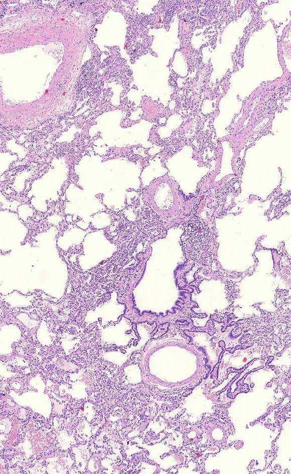 Neutrophils Inflammation B cells 64% Bronchitis Follicular
