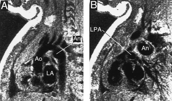 Right, The parasternal short-axis view shows extension of the thrombus into the branch pulmonary arteries with near total occlusion of the LPA.