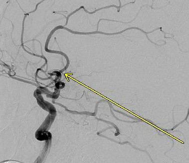 Use of the System for Endovascular 77 y/o Male Sudden right facial droop, right-sided weakness, and aphasia Transported by EMS to community hospital Pt