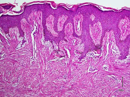 Histologic evaluation among five ALMs revealed two solid, two cavernous and one venous type as described in previous articles (6).