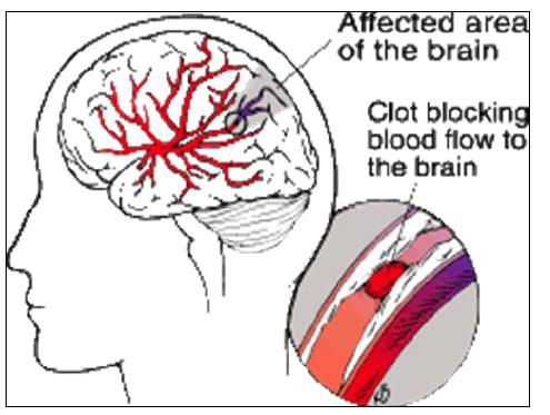 Strokes A clot may break off from another place in the brain, or other part of the