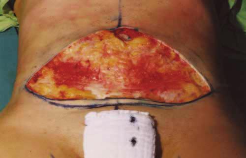 Moreover, the classic abdominoplasty may require further postoperative reinterventions to correct scars and dog ears.
